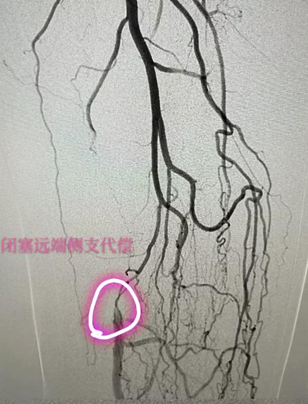 下肢血管引起的腿软无力,下肢动脉闭塞会引起腿无力吗