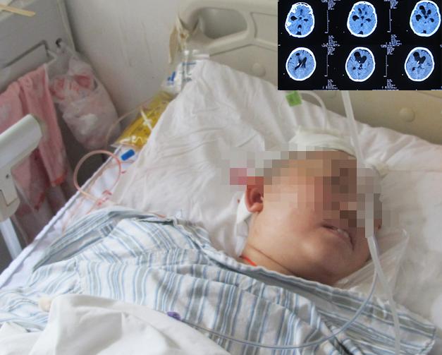 结核性脑积水,脑膜炎脑积水要治疗多久