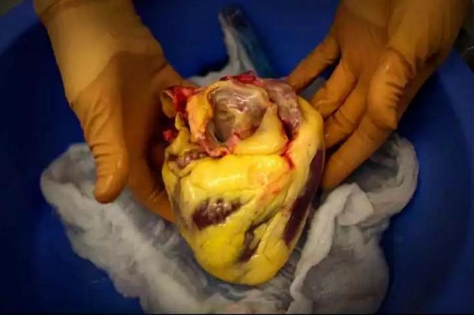 体检脂肪过量怎么说,体检内脏脂肪