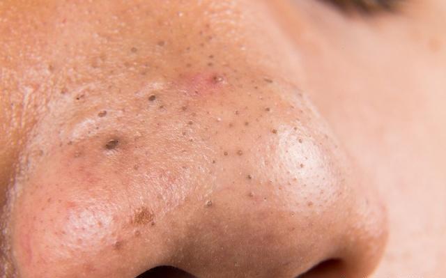 痘痘怎么挤才是正确的视频,痘痘怎么挤闭口