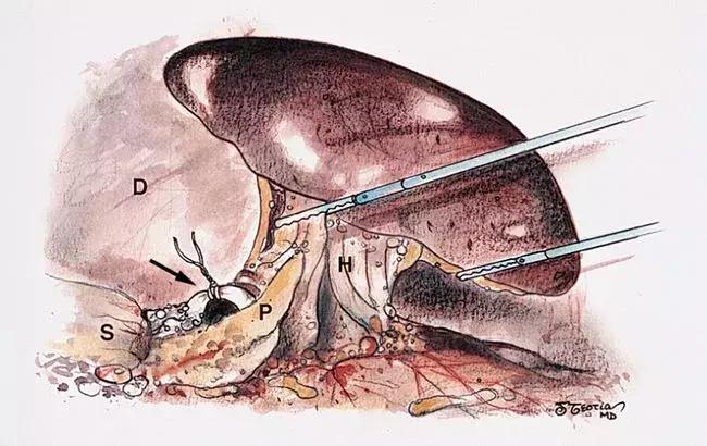 脾脏增大的原因和危害及治疗,脾脏切除的注意事项和以后的影响