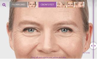 肉毒毒素注射常见问题答疑,扒一扒玻尿酸的副作用