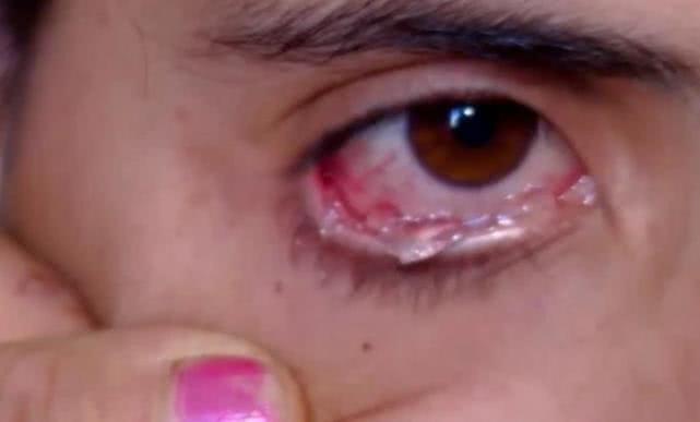 女子得了罕见怪病眼睛流出血,女子眼睛流出钻石眼泪