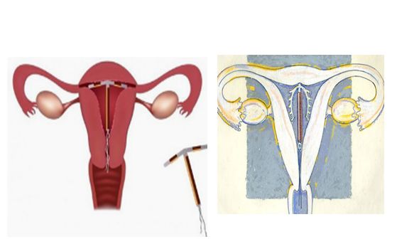 绝经后被遗忘在身体里的节育环，可能是一颗定时*弹炸**