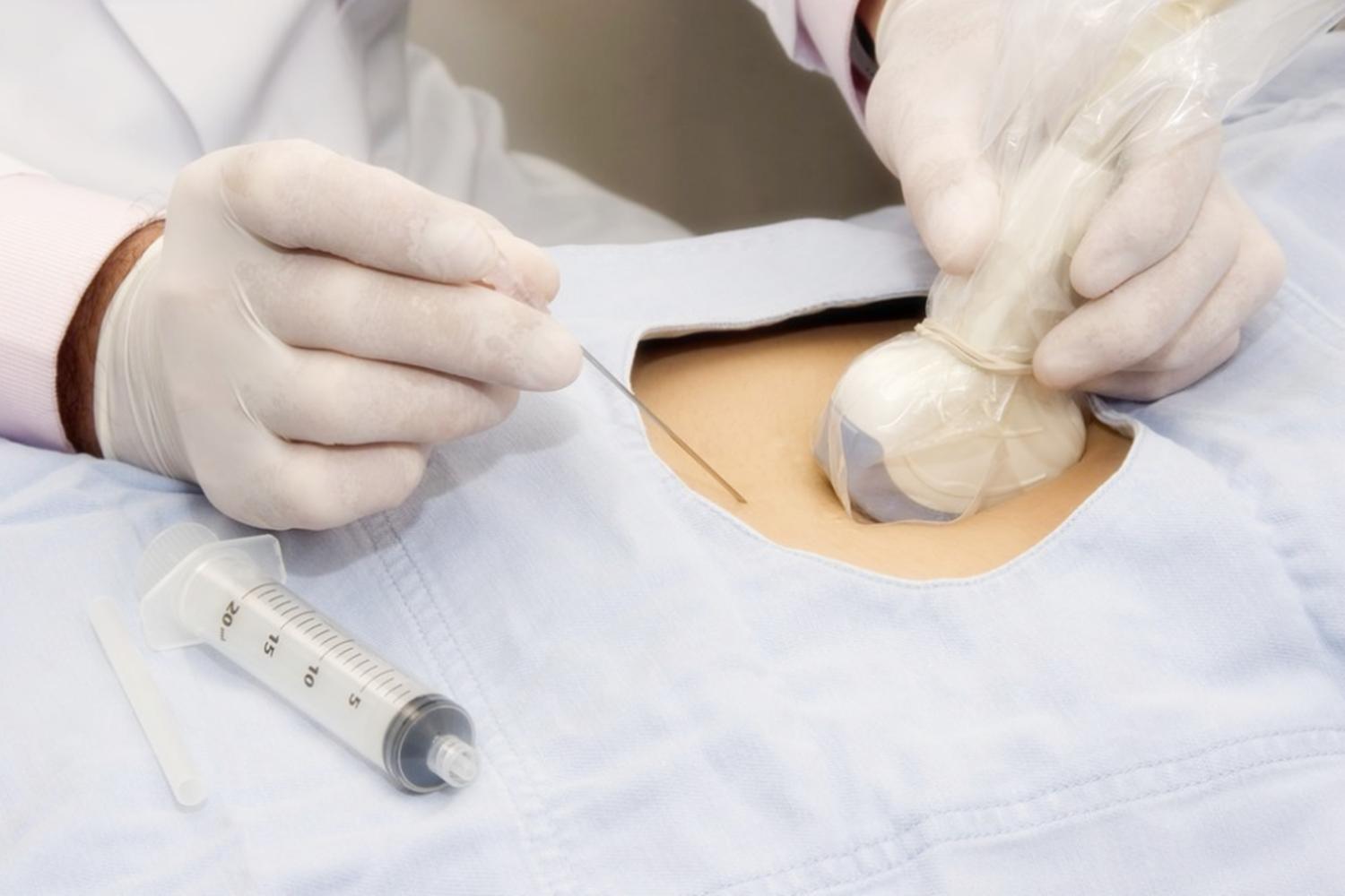 在孕期，什么情况下需要做羊水穿刺？了解后没必要过分担心