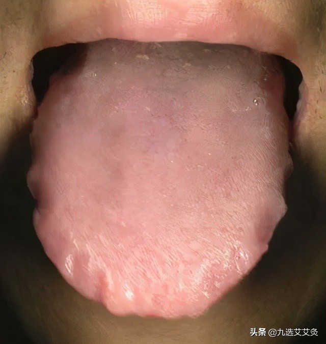 新冠肺炎艾灸哪个部位最好,新冠肺炎中医艾灸干预方案