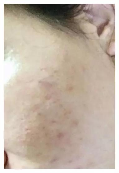 医美祛痘真实经历,微针祛痘坑真实经历