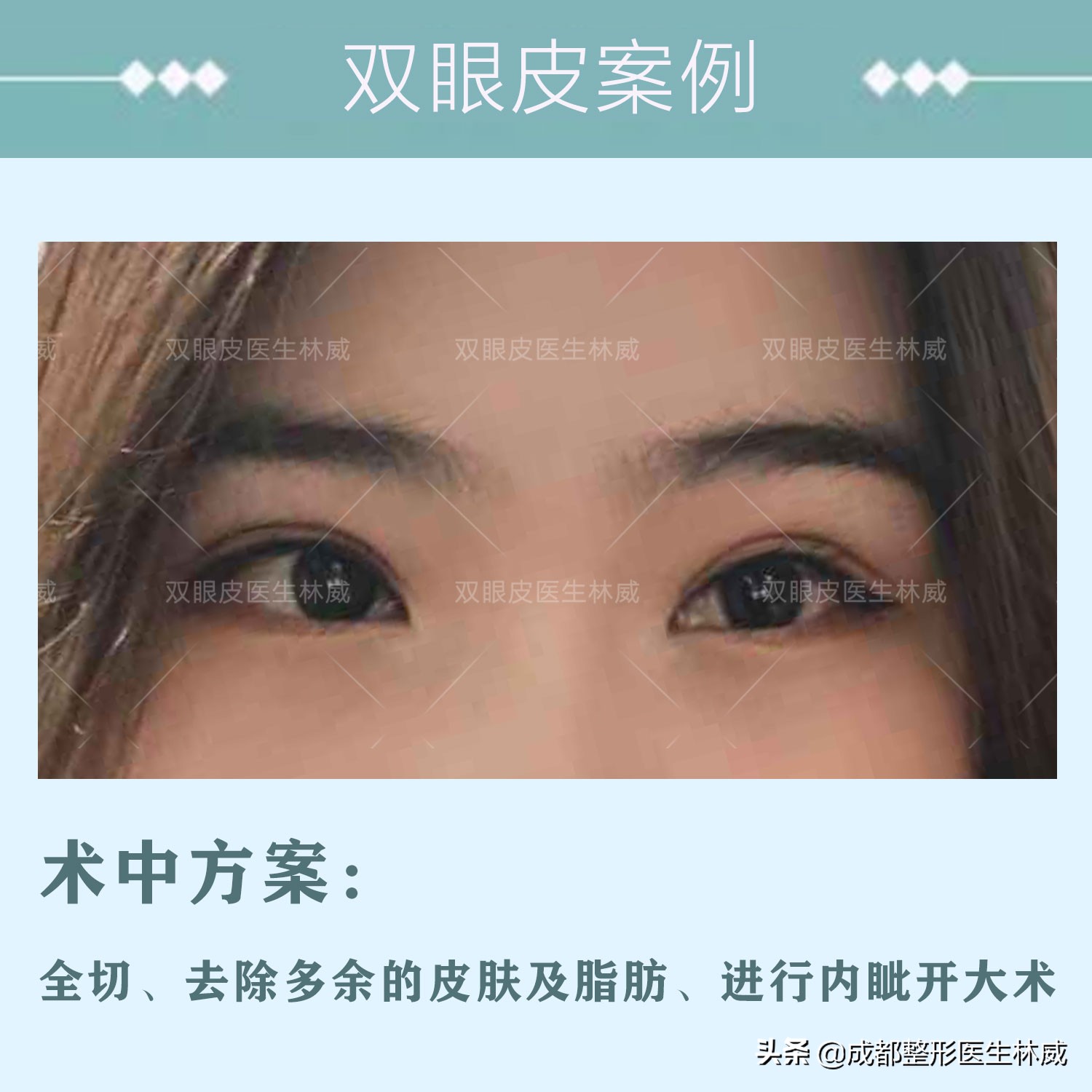 成都林威双眼皮多少钱,成都双眼皮林威医生