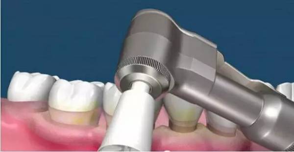 洗牙到底怎么洗好,洗牙洗的不干净