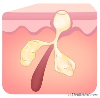 痘痘粉刺护理,痘痘粉刺闭口怎么调养皮肤