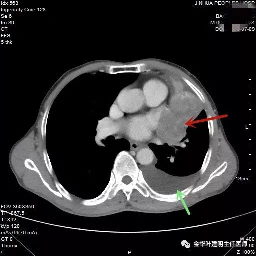 肺癌伴胸腔积液伴膨胀不全,肺癌晚期转移到肝脏引起腹腔积液