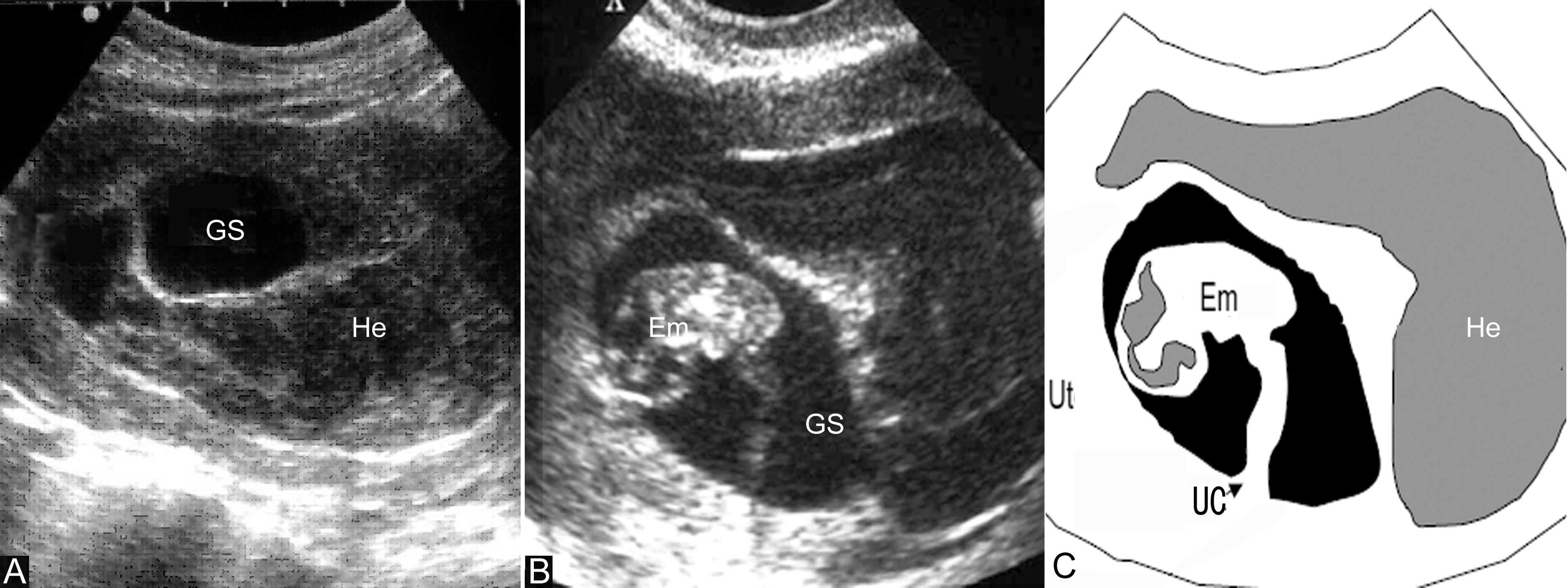 经阴超声检查可以看出来流产吗,流产残留超声诊断