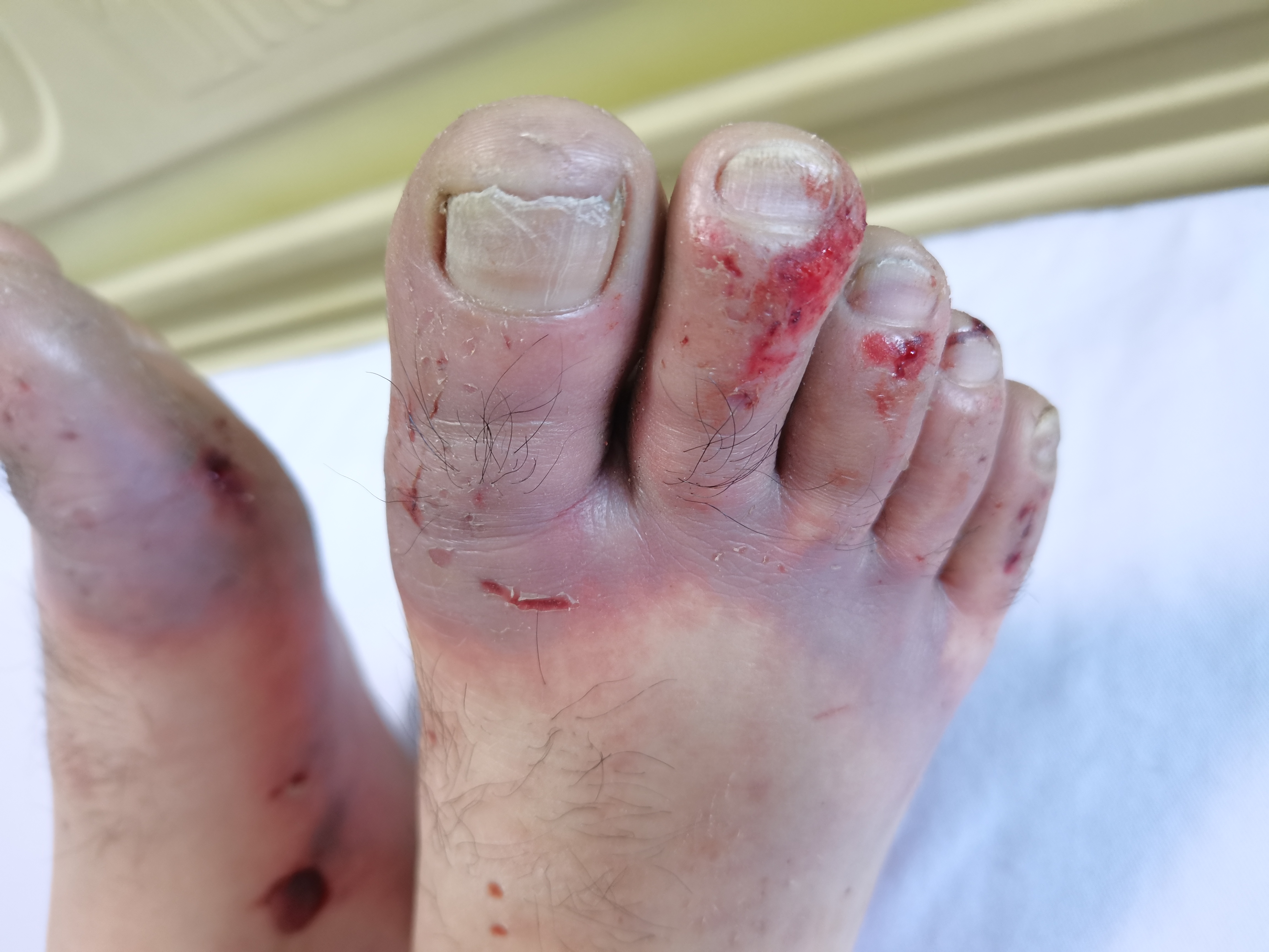 冻伤该如何处理,液氮冻伤处理方法