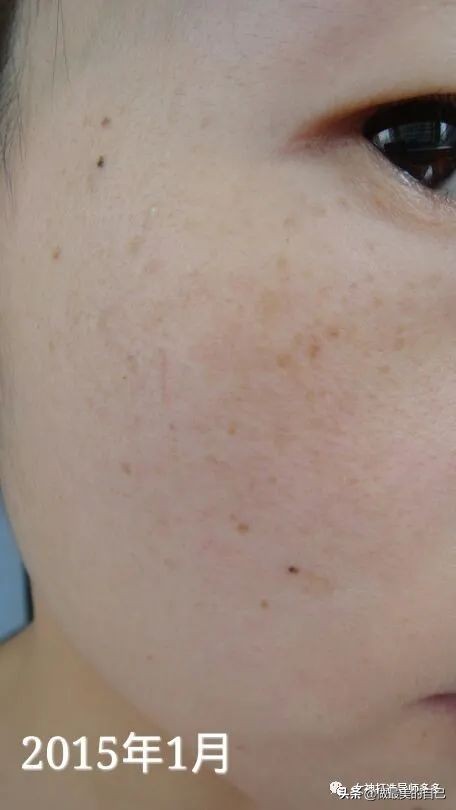 斑点暗黄肌最全的改善小技巧,都在这里