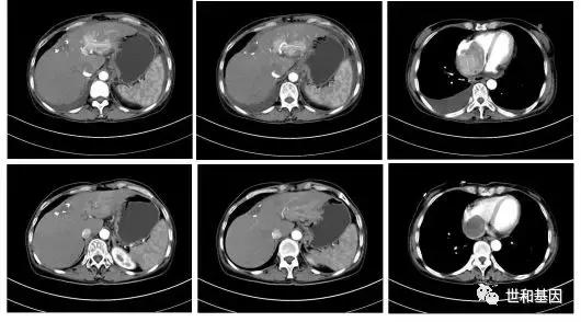 精益求精，抗血管和免疫药物的临床应用经典病例丨束永前教授