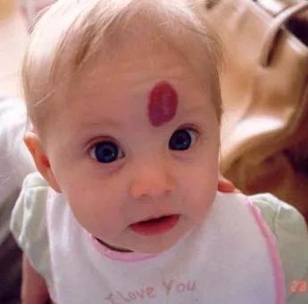 眼药水对血管瘤的作用,眼药水血管瘤副作用