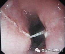 快速把鱼刺拿掉,最管用的鱼刺剔除方法