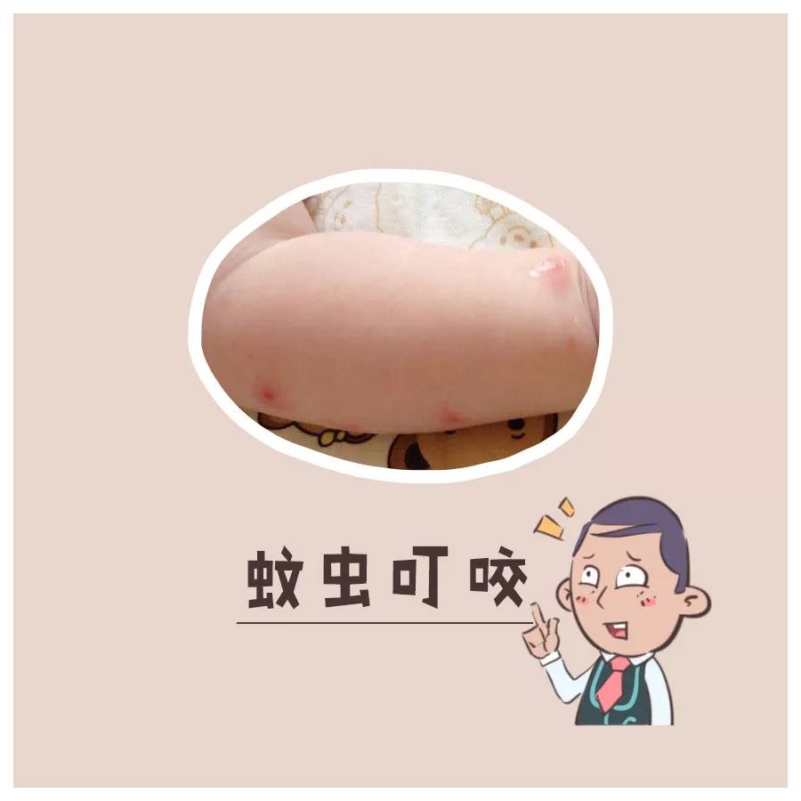 天气热怎么对付痱子,天热起痱子有什么好方法