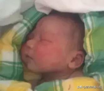 粟粒疹宝宝,宝宝红斑丘疹鉴别图谱