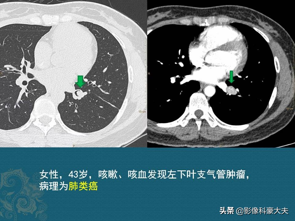 这5种癌一发现就是晚期,第一例癌症患者治愈