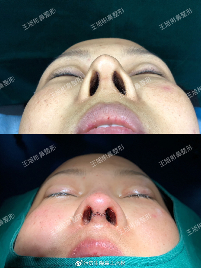 天生鼻小柱歪斜有必要修复吗,天生鼻子歪做肋骨鼻可以矫正吗