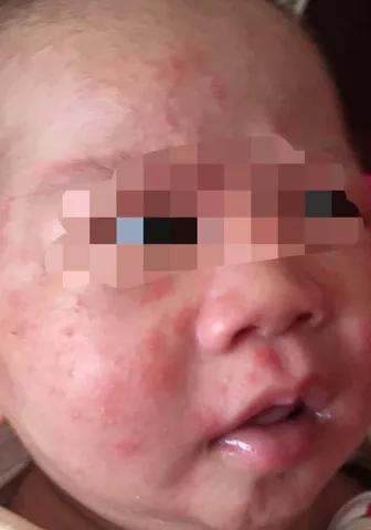 婴儿湿疹宝妈可以吃带鱼吗,婴儿湿疹吃母乳宝妈要忌口吗