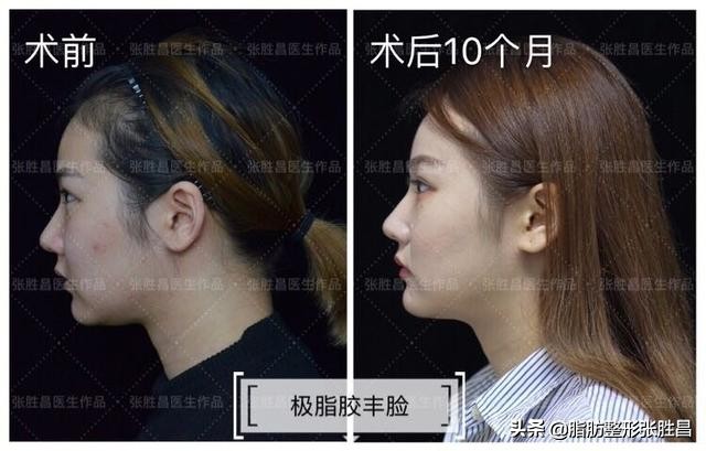 极脂胶丰额角太阳穴下巴｜22岁的自己竟比18岁的要漂亮多了