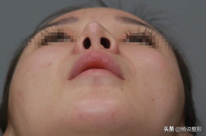 隆鼻失败的常见原因有哪些,隆鼻失败最快的解决方法