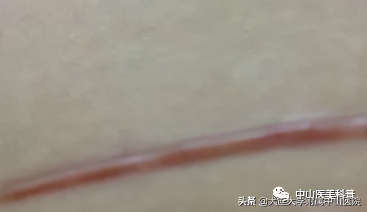 疤痕祛除咨询,一些疤痕的治疗效果图