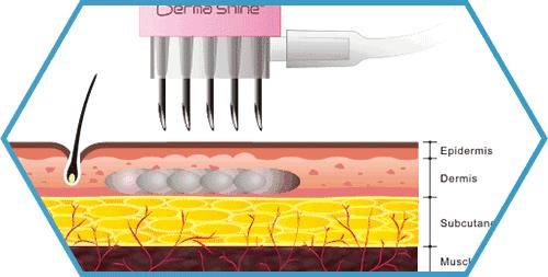 美容黑幕,美容仪内幕大揭秘