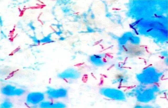 怀疑肺结核必须要做气管镜检查吗,痰里找到结核杆菌就说明肺结核吗