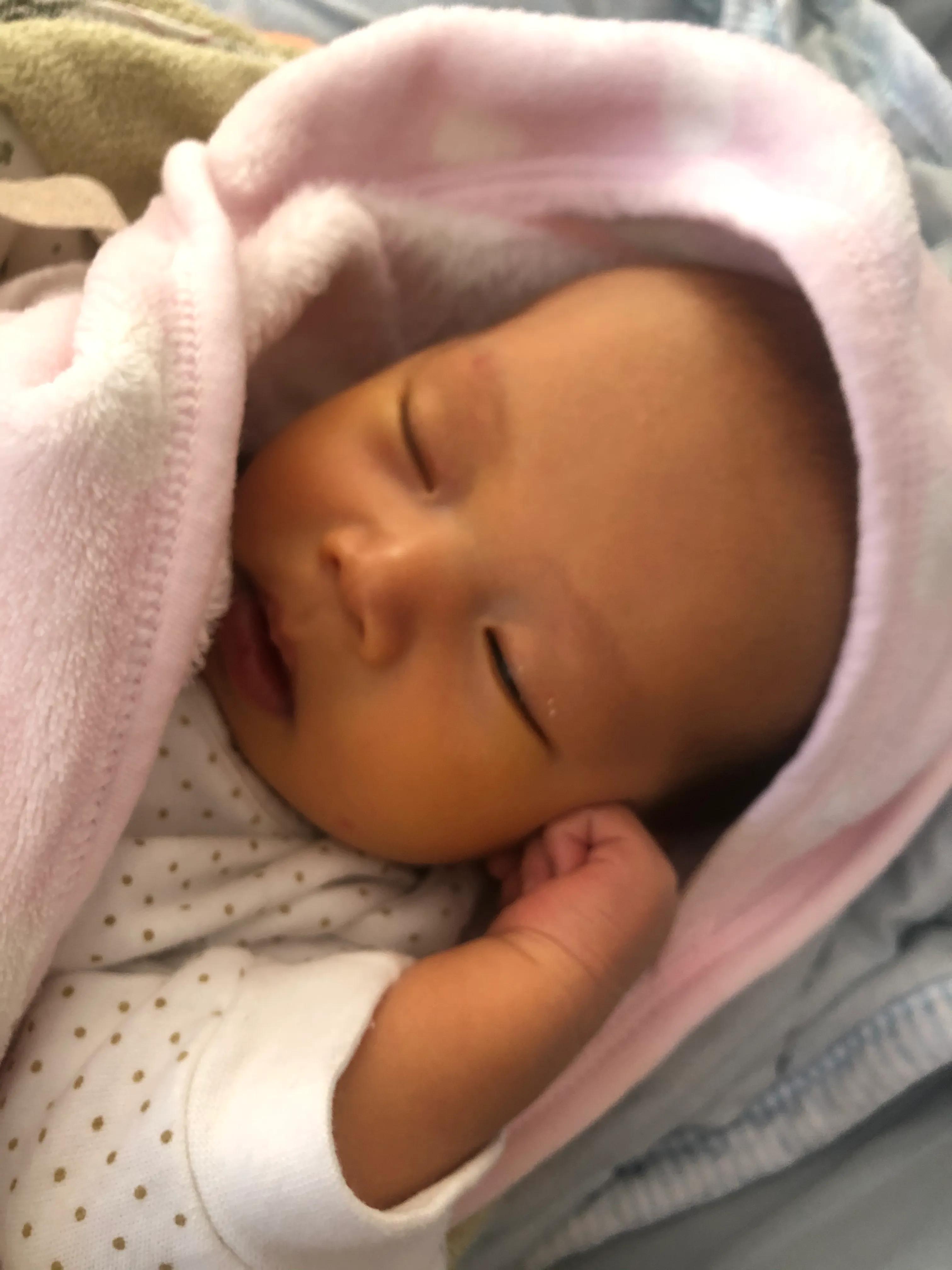 20天的宝宝黄疸高眼球黄,新生儿20天黄疸不退眼睛周围还黄