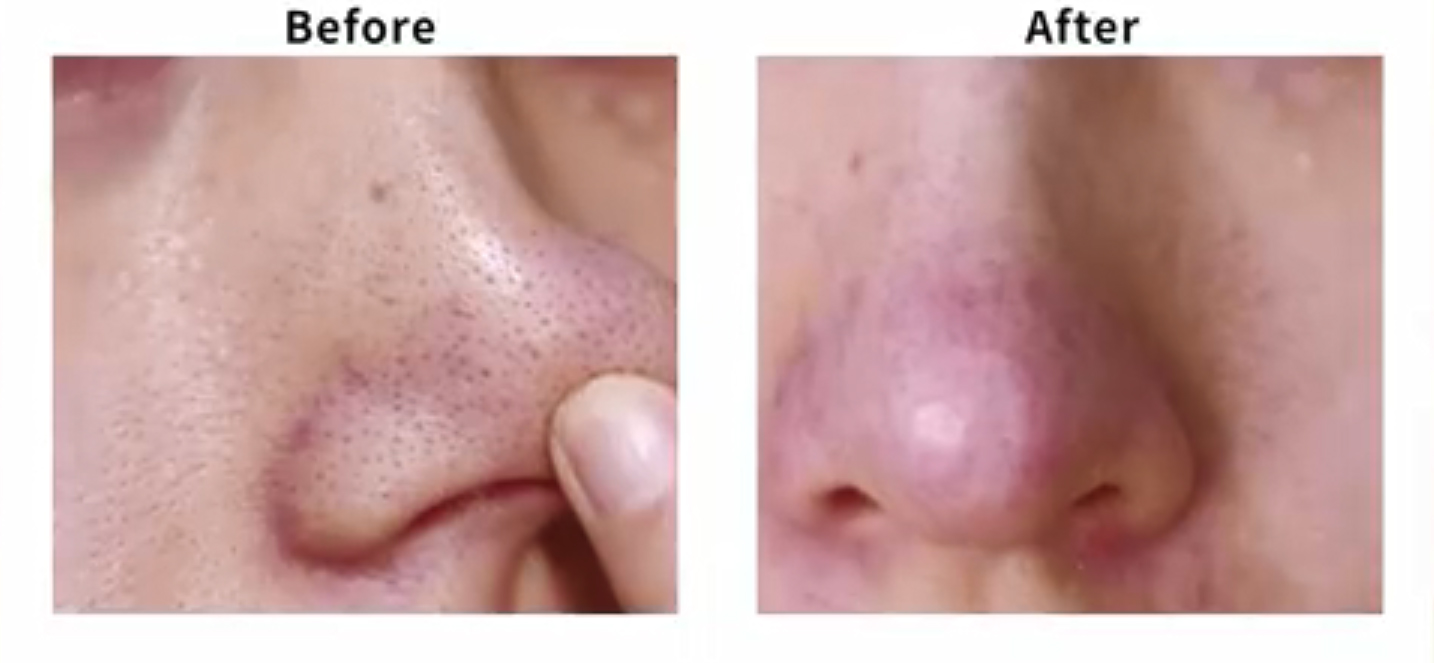 黑头多怎么办干货,黑头挤完了怎么处理才不会留痘坑