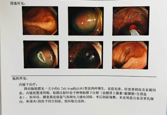 艾灸治疗胃肠息肉,中医治疗胃肠息肉的方法
