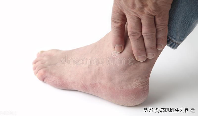 痛风发作大脚趾不能活动,痛风发作时只痛不肿不热为什么