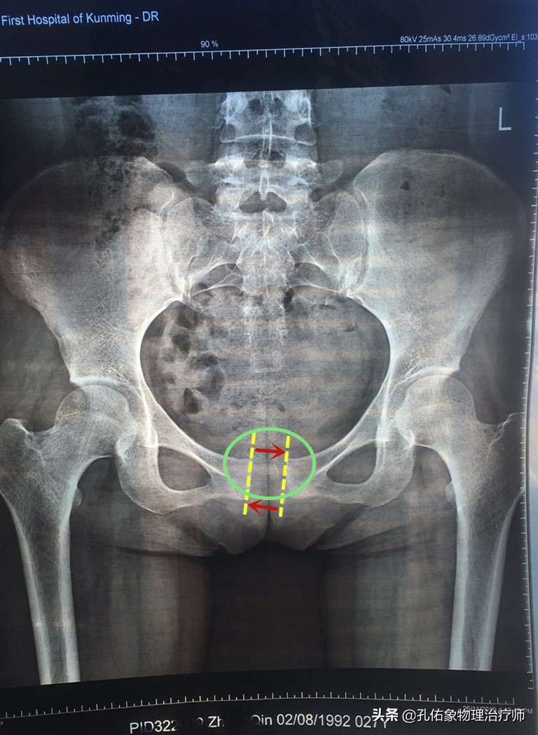 女大腿根内侧疼痛是什么原因,女性左大腿内侧根部疼是怎么回事