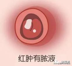 脐带脱落前有黄色分泌物正常吗,脐带脱落后出血新生儿脐带护理