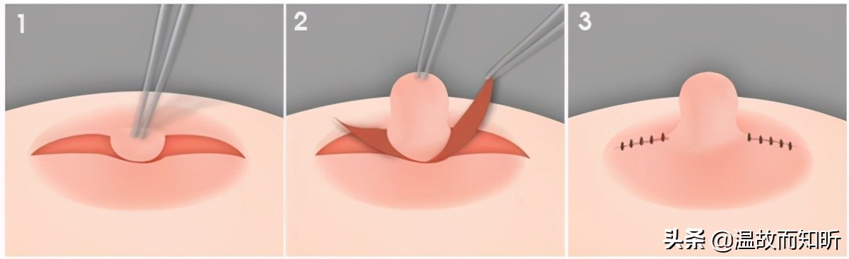 母女都是乳头内陷，检查出来的结果却不相同