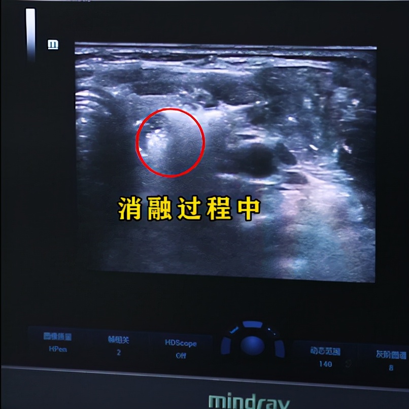 甲亢眼睛突真实案例,甲亢现状