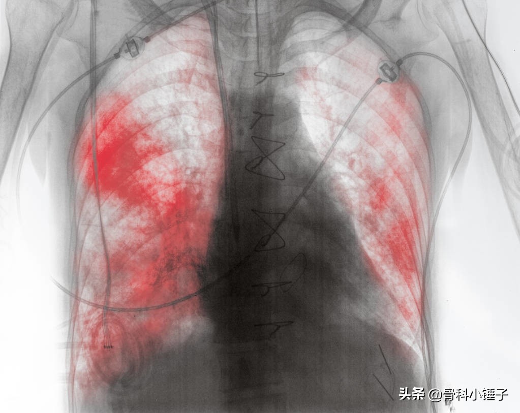带状疱疹后遗症中药良方,带状疱疹后遗症表现