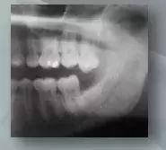 那些不拔智齿的人后来都怎么样了,那些该拔不拔的智齿最后都咋样了