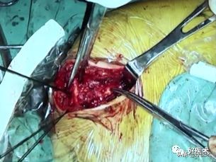 治疗肩锁关节脱位，有最好的方法吗？