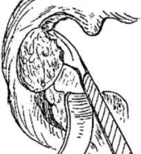 「慢性扁桃体炎」必须要知道的七大要点