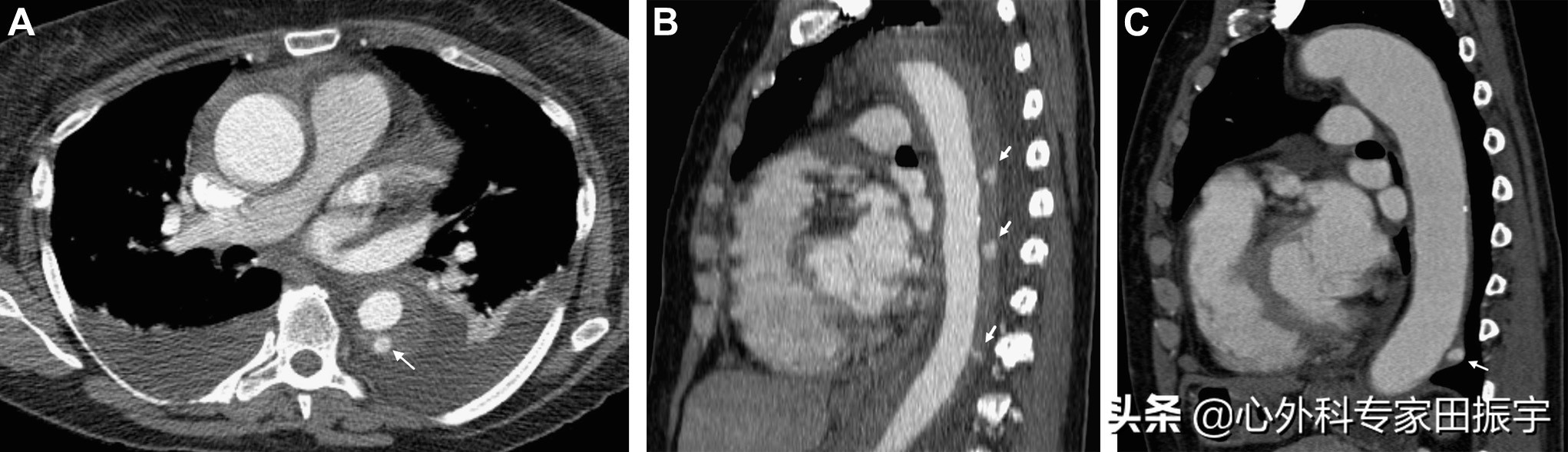 主动脉血肿危险期,高危脑动脉瘤破裂出血