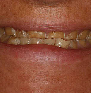 长期过度饮酒对牙齿的危害,长期吸烟喝酒的牙齿长什么样子