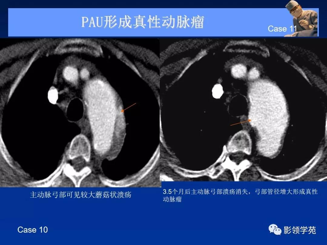 主动脉夹层壁间血肿如何鉴别,主动脉夹层血肿溃疡