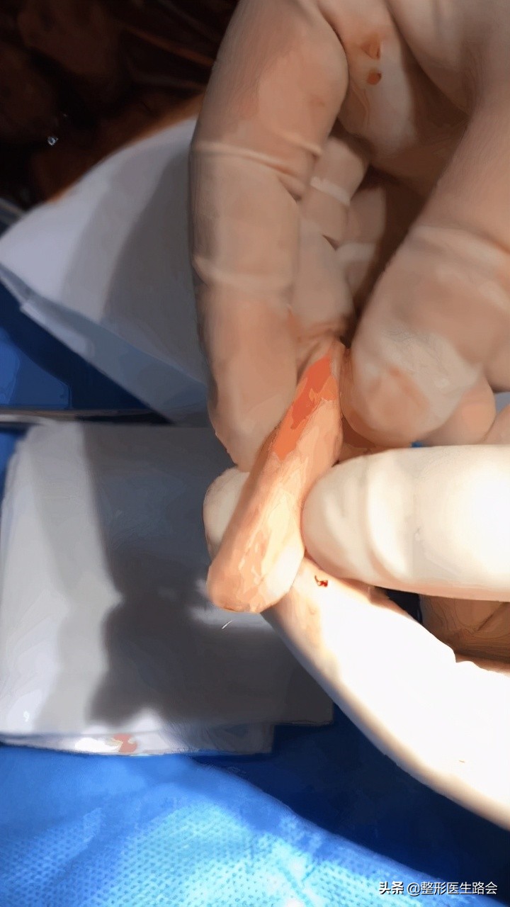 假体材料都有哪几种,假体材料都有什么