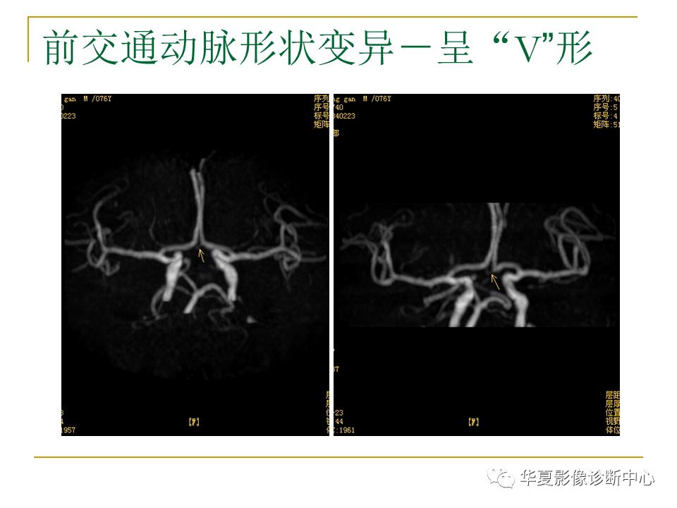 中国人脑立体定向mri应用解剖图谱,脑mri示意图