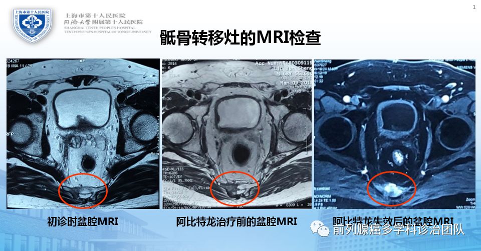 前列腺癌精准诊疗,前列腺癌辅助放疗和挽救放疗