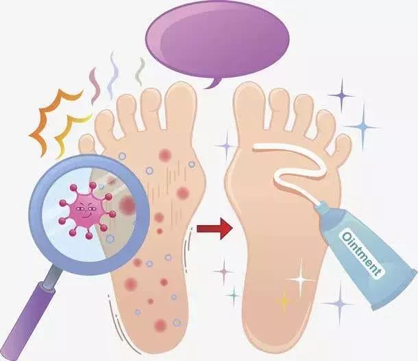 夏天不想穿凉鞋又怕得脚气怎么办,脚气夏天穿不了凉鞋怎么办